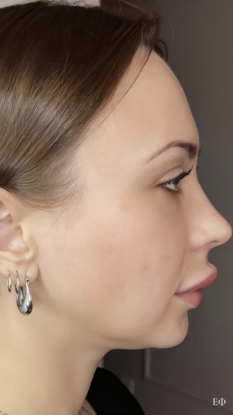 До — FullFace, фото 3